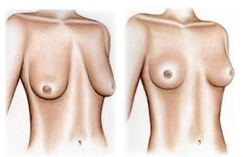 cheap breast lift surgery abroad